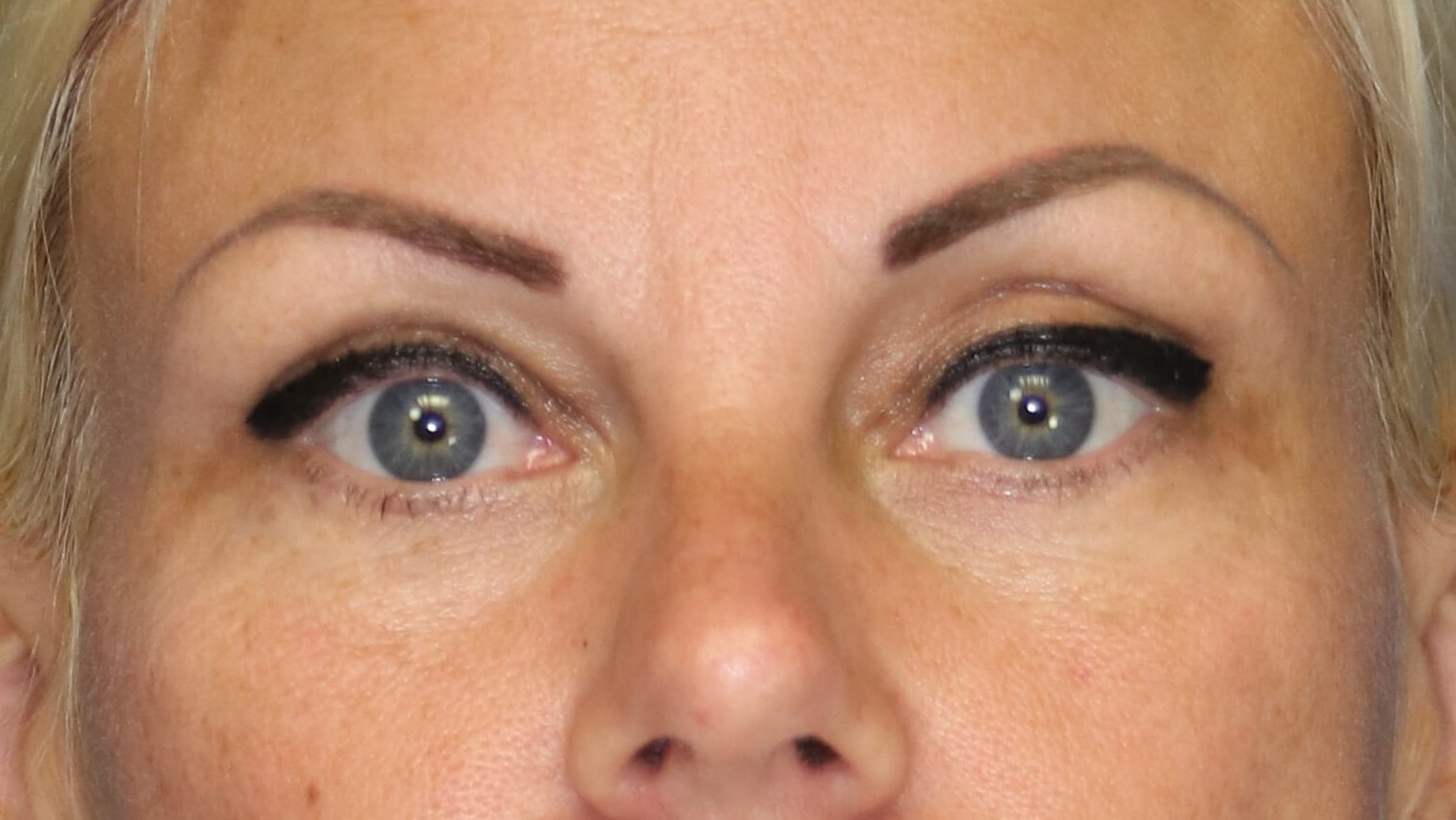 Left upper eyelid volume defic
